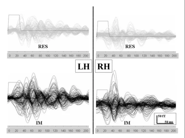 Fig 1. MEG waveforms (300 trials averaged) from evoked cortical responses in both hemispheres during a somatosensory trial (upper) and imagined movement (lower)