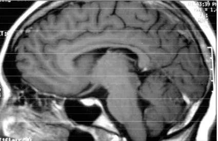 Fig 2. MRI, T1 weighted sagital view, showing a non-enhanced tectal mass.
