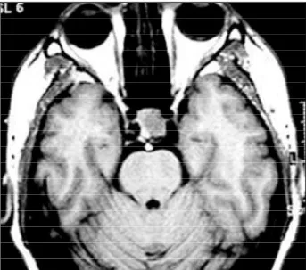 Fig 3. MRI showing pituitary tumor without expansion out of sellar space.
