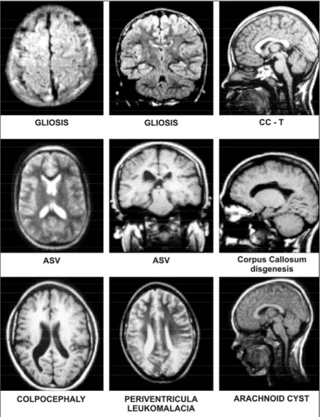Fig 2. The most frequent MRI findings. See text for further details.