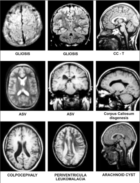 Fig 2. The most frequent MRI findings. See text for further details.