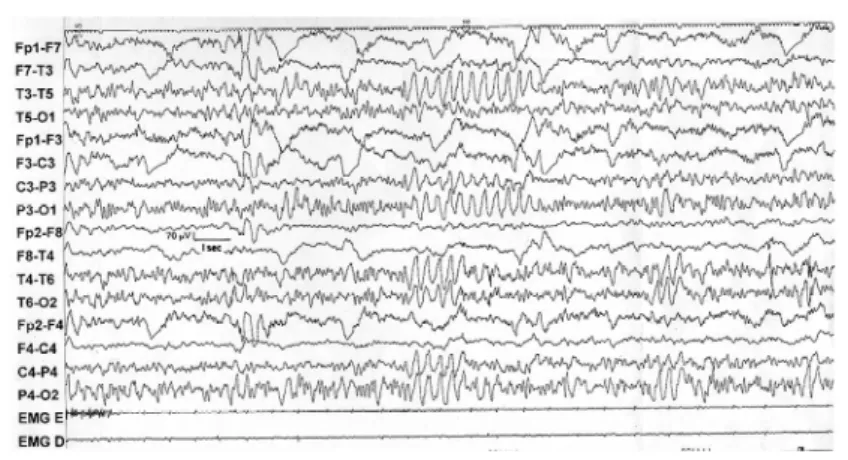 Fig 1. EEG showing OIRDA during hyperventilation fol - -lowed by absence seizure accompanied by generalized SWC