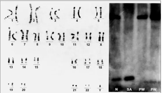 Fig 1. Frontal view of the propositus at 1 year and 9 months of age.