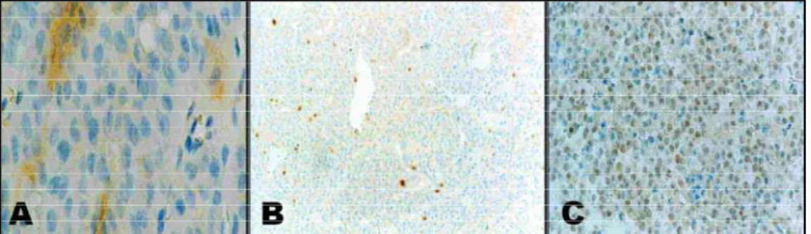 Fig 3. Grade 3 intensity of membrane staining for c-erb B2. A:200X; B:400X; C:200X.