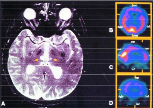 Fig 1. A) MRI with T2 weighted images, with arrows pointing to the infarcted areas corre s p o n d i n g to the thalamic paramedian terr i  -t o ry; B),  C) and D) SPECT showing bilateral frontal hypoperf u s i o n (transverse, sagital and coronal sec  -ti