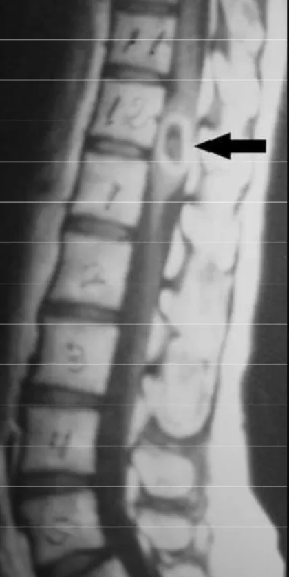 Fig 2. Surgical excision of the intramedullary cyst. A) The tough and tense dural sac.