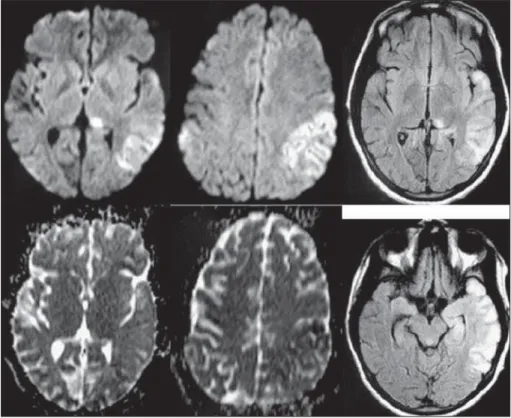 Fig 2. Diffusion-weighted images (DWI) and T2-weighted images FLAIR exhibited abnormal  hyperintense signals in bilateral temporal and insular cortices.