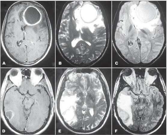 Fig 1. Large frontal rounded lesion in patient 1 (A, B, C) and temporal lesion in patient 2 (D, E, F) both  with similar signals: hyperintense with hypointense halo in T2 (A and D) and FLAIR (B and E),  hypoin-tense in T1 with peripheral enhancement (C and