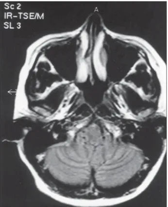 Fig 4. Tonsile herniation observed during the operation in sit- sit-ting position.