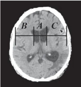 Fig 2. Data for the calculation of bicaudate cerebroventricu- cerebroventricu-lar index (BCVI)