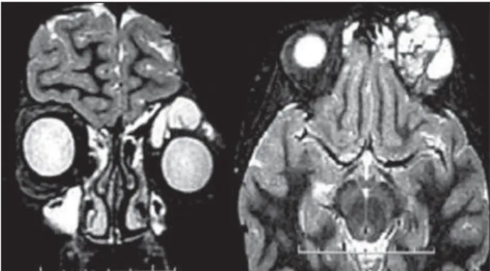 Fig 2. Coronal e axial T1 sequence of post-operative MRI, show- show-ing resection of the lesion.