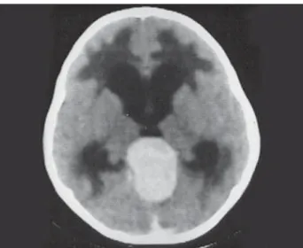 Fig 2. Case 1. Histological features of  ﬁ  broblastic meningioma.