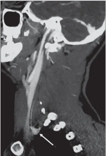 Fig 2. Chest CT scan revealing mediastinal hematoma extend- extend-ing to the left apex (white narrow).