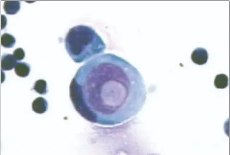 Fig 2. CSF, lung adenocarcinoma cell, Light microscopy (May- (May-Grünwald/Giensa stain, 1,000X)