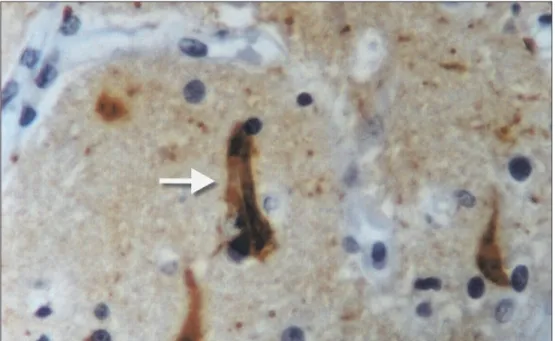 Fig 3. Imunohistochemistry of frontal cortex: tau protein deposits: polyclonal antibody X 400.