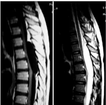 Fig 2. Macroscopic aspect of surgical treatment showing the  extradural cystic lesion.