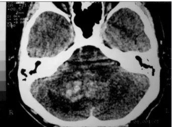 Fig 1. CT scan disclosing a cerebellar heterogeneous and ir- ir-regular lesion.