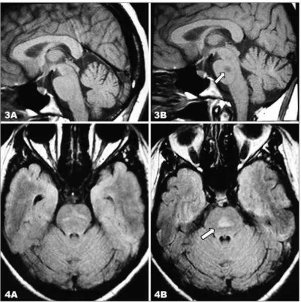 Fig 3. (B) Sagittal T1-weighted image showing hypointense lesion in the pons and Fig 4 (B) axial FLAIR im- im-age shows an increased signal in the same region (the arrows are showing the lesions)