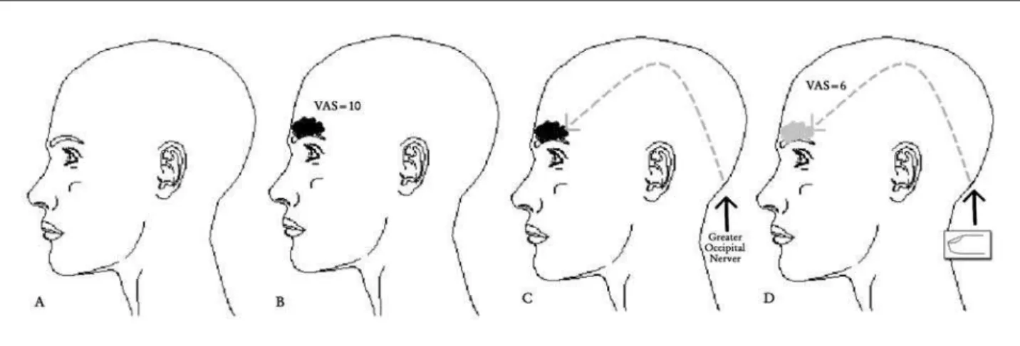 Fig 1. Distribution and evolution of the symptoms during migraine attacks. (A) Normal situation; (B) Topography and intensity of  the initial symptoms; (C) Local of the massage during the migraine attacks; (D) Behavior of the pain during migraine attacks a