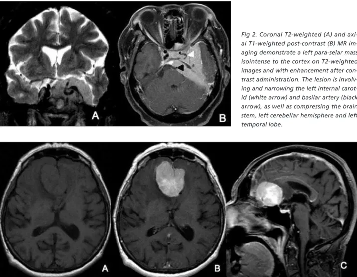 Fig 2. Coronal T2-weighted (A) and axi- axi-al T1-weighted post-contrast (B) MR  im-aging demonstrate a left para-selar mass  isointense to the cortex on T2-weighted  images and with enhancement after  con-trast administration