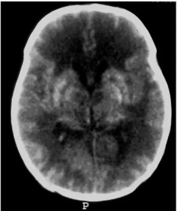Fig 1. Unenhanced CT showing large areas of the white matter  hypodensity and bilateral basal ganglia hemorrhage.