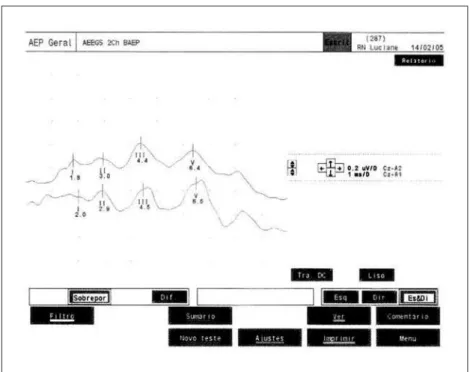 Fig 3. Brainstem auditory evoked potential reveals normal.