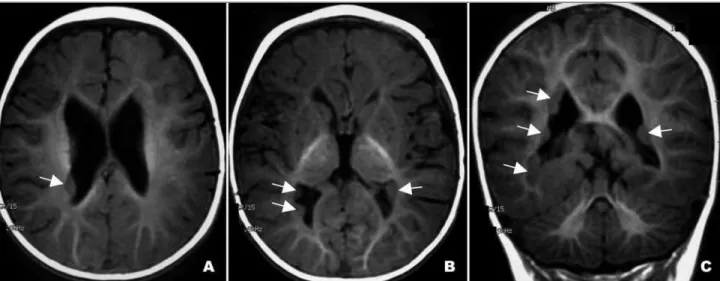 Fig 2. MRI showing agenesis of the pituitary stalk on T1-weight- T1-weight-ed coronal cut.