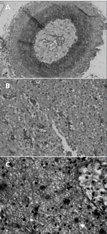 Fig 2. Cranial CT showing volumetric reduction of the cerebral  hemispherium and hypodense areas in the right-temporal,  left-frontal and bilateral occipital regions compatible with  infarc-tions (arrows) in patient number one (A) and an area of  cere-bral