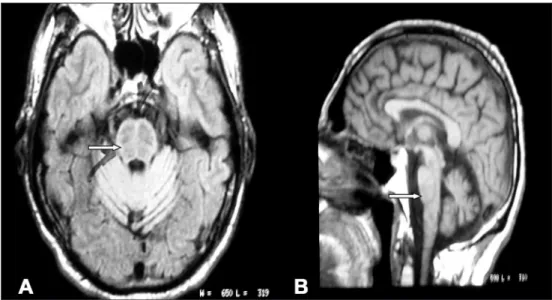 Fig 2. Case 2. MRI: (A) Marginal hyper intensity in T2 image (arrow). (B) Putaminal hypo intensity in  T1 image (arrow).