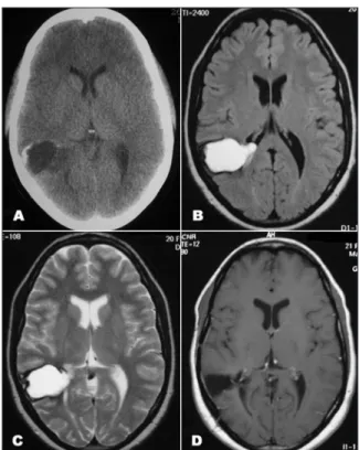 Fig 1. (A) Axial CT Scan showing hypodense lesion in tem- poral lobe, with calcification