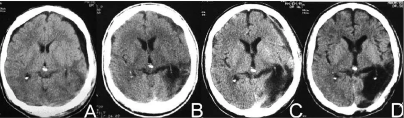 Fig 1. Case 1. (A). CT scan showing left frontal subdural hygroma (9 th day). (B) Enhanced density and heterogeneous appear- appear-ance (53 rd day)