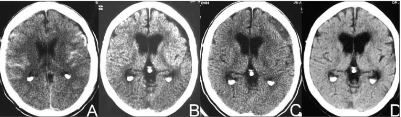Fig 4. Case 4. (A) CT scan on admission showing subarachnoid hemorrhage and cerebral edema (1 st day)