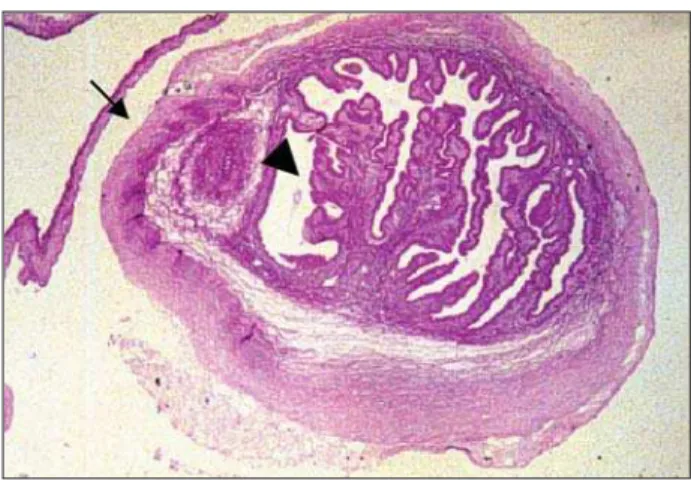Fig 2. Cysticercus in destruction in meningocortical localiza- localiza-tion. Fibrous connective tissue (arrow) neoformation is observed in the parasite, in the host-parasite interface and in the host tissue (Picro red, 50X).