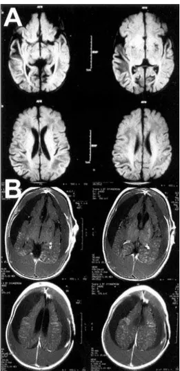 Fig 2. MRI, with axial slices revealed that: (A) at two months of age showed hypointensities of white matter, with higher signal intensity over right temporal lobe; and (B) at seven months of age T1-weighted slices showed hematomas  rang-ing from isointens