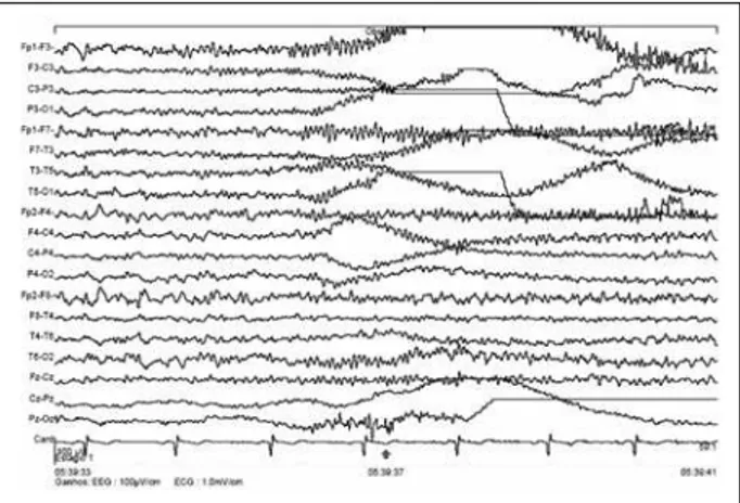 Fig 3. Epoch with 8 s of EEG. The ictal EEG seizure pattern is dominant in the left hemisphere