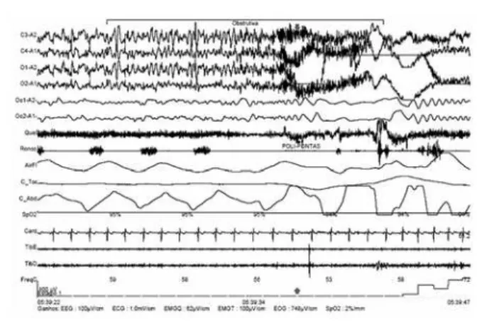 Fig 6. Epoch with 40 s of standard PSG, showing an obstruc- obstruc-tive sleep apnea ending with an ictal EEG seizure pattern and in the video registration we can see an automotor crises.
