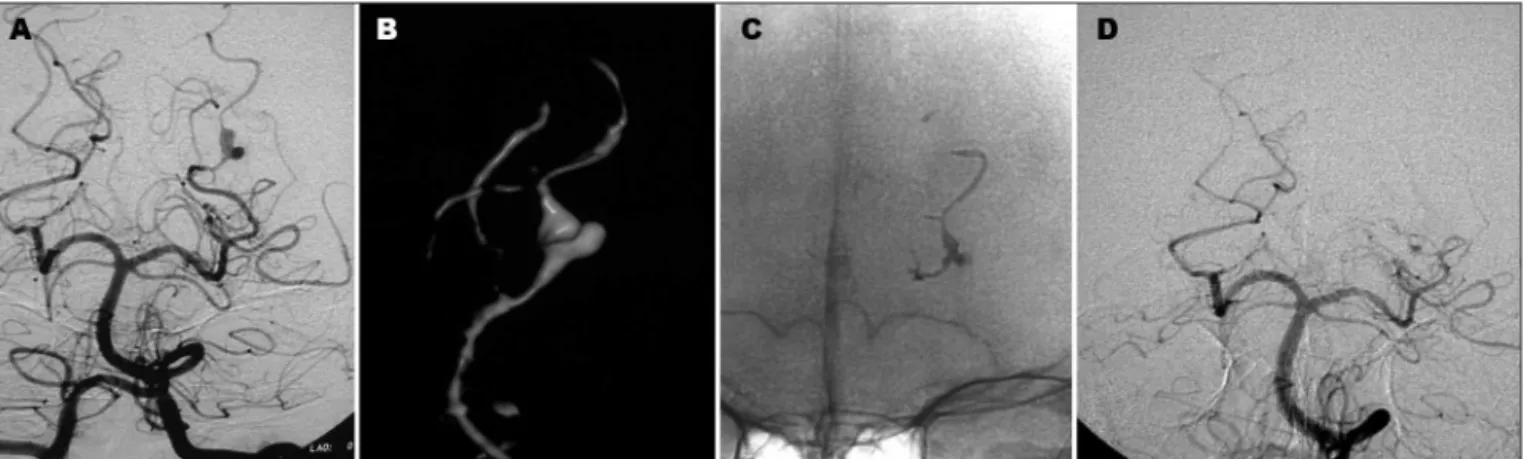 Fig 3. Patient 4. Left P2 aneurysm. (A, B) Angiogram and 3D rotational angiography shows well depicted bilobulated aneurysm dome before  treatment