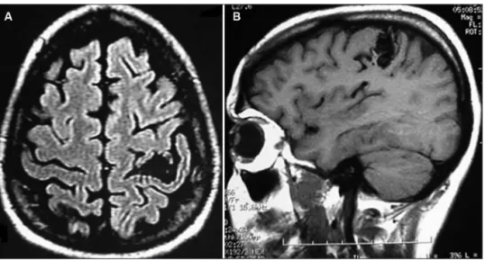 Fig 1. (A) The MRI helps localizing the lesion. Axial lair magnetic resonance imaging revealing hiposig- hiposig-nal area in the central sulcus