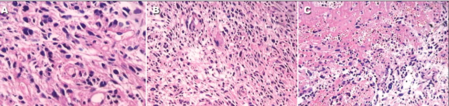 Fig 2. Light microscopy of the surgical specimen. H-E stainig. (A) Glial neoplasm with intense cellular pleomorphism (100x objective)