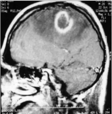 Fig 1. Patient 1. MRI showing a round lesion at the right parietal lobe  surrounded by an enhanced gadolinium ring and oedema.