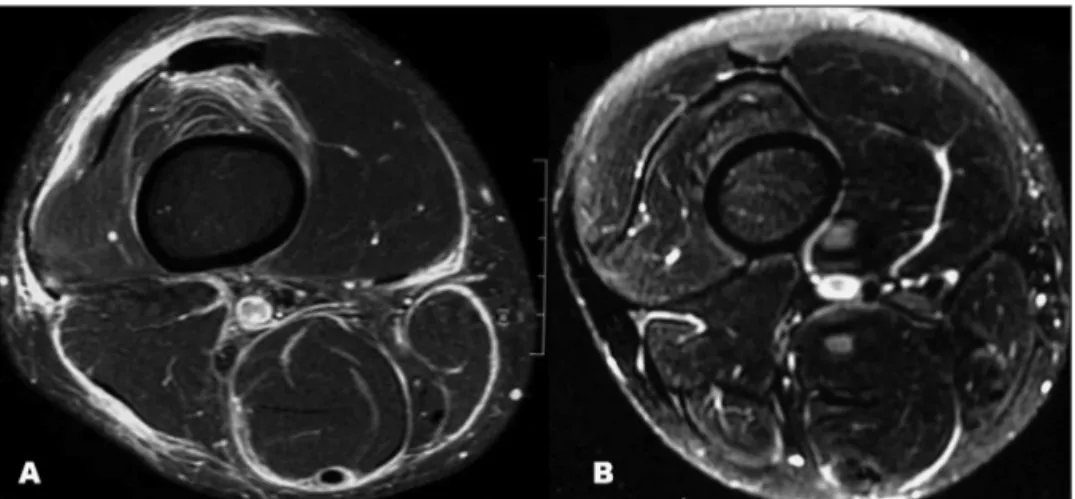 Fig 1. (A) MRI of the right knee showing edema of soft adjacent parts to the muscular bellies of the  evaluated segment, of circunferencial aspect, and there was intense contrast enhacement