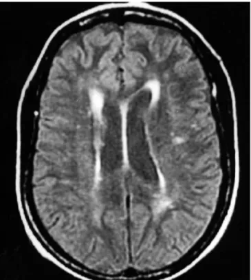 Fig 1. MRI of the brain, axial section of a patient diagnosed with  Hashimoto’s encephalopathy