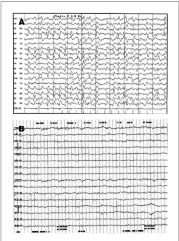 Fig 2. EEG of a 68-year-old the patient diagnosed with Hashimoto’s  encephalopathy. (A) At admission- presence of triphasic complexes