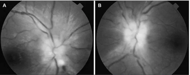 Fig 1. Papilledema at presentation: right (A) and left (B) eye.