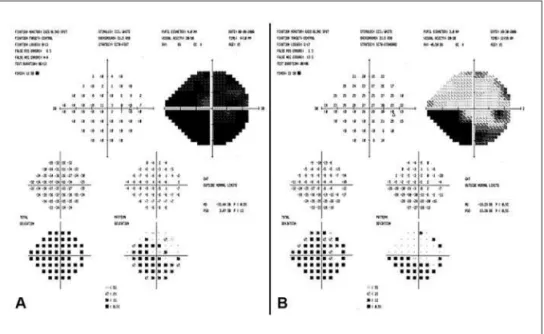 Fig 2. Right eye campimetry performed at the forth (A) and the thirtieth (B) day of hospitalization.