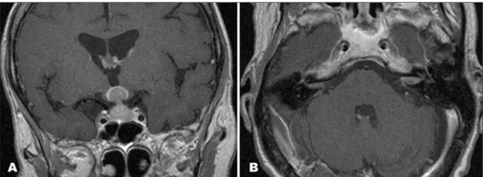 Fig 1. Cranial gadolinium-enhanced T1-weighted MRI. (A) Coronal image showing tumour extension to the hypothalamus