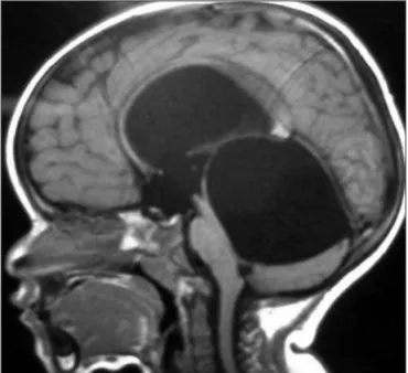 Fig 1. SagitTal T1 MRI at diagnostic evaluation: large quadrigeminal  cyst causing hydrocephalus and compressing the brainstem and the  fourth ventricle.