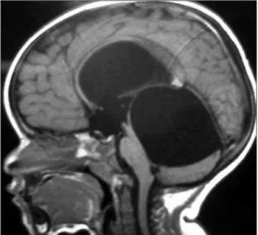 Fig 1. SagitTal T1 MRI at diagnostic evaluation: large quadrigeminal  cyst causing hydrocephalus and compressing the brainstem and the  fourth ventricle.