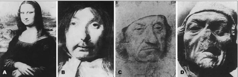 Fig 4. (A) “Mona Lisa” by Leonardo da Vinci. At a meeting of the facial nerve in Zurich, Adour and Jongkees concluded that the “Gioconda” had  right peripheral facial paralysis (Adour and Jongkees personal communication, 1987)
