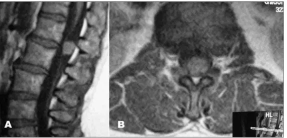 Fig 6. T1 weighted MRI of the lum- lum-bossacral spine demonstrating the  tumor nodule with homogeneous  enhancement of contrast in the  region of the ilum terminale ((A)  sagital; (B) axial).